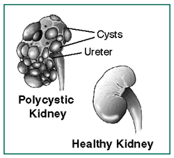 Polycystic Kidney Disease (PKD) | Definition Of Polycystic Kidney ...